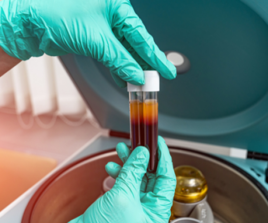 Plasma rico en plaquetas